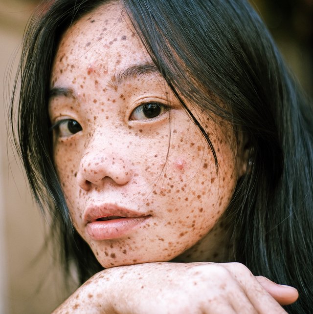 What causes acne ? – Dr. Pen Store