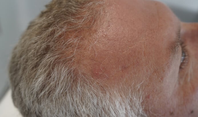 Hairline before tricology