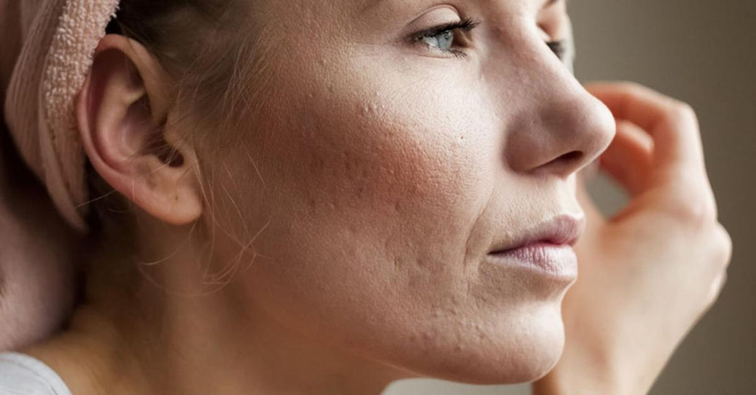 Microneedling for Scar Treatment