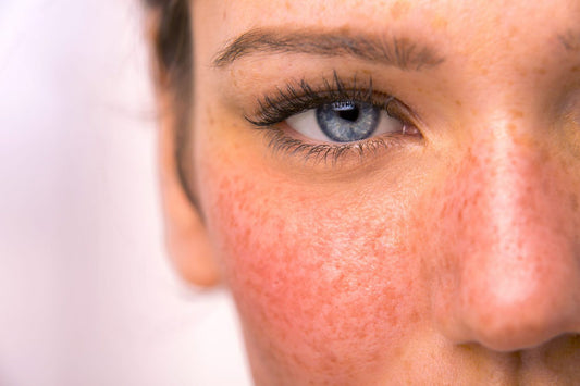 Rosacea Skin Care? You need to know about