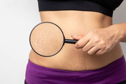 5 Reasons Why Stretch Marks Occur and Why Dr. Pen Is the Best Treatment