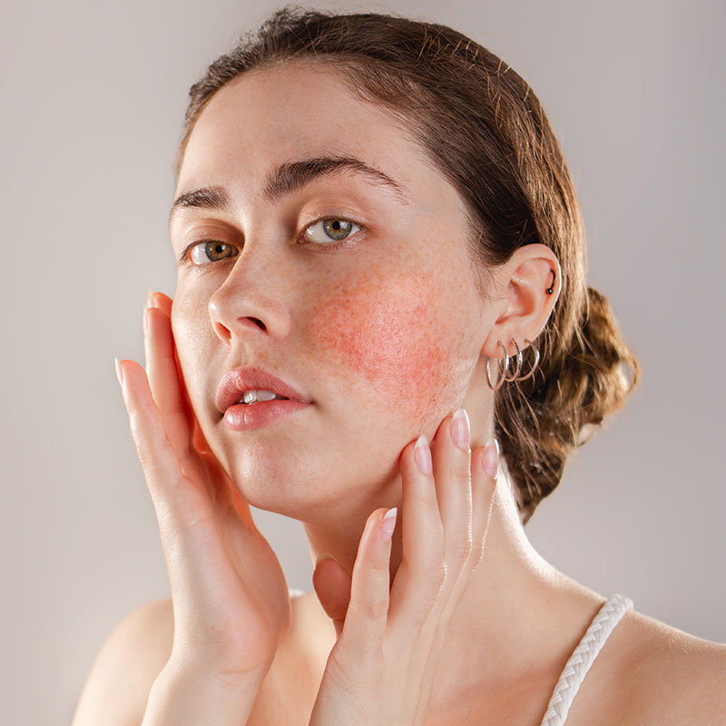 5 Signs You Need Microneedling Treatment