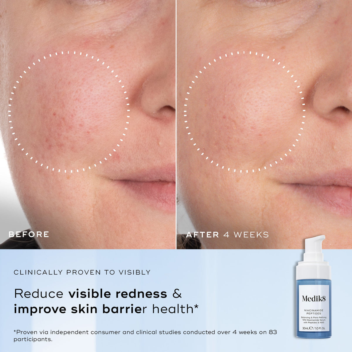 Niacinamide Peptides before and after 4 weeks, redness and skin barrier