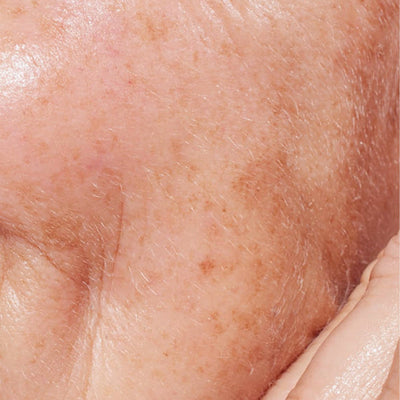 Close-up of dark spots and uneven skin tone on the cheek - skincare for dark spots and pigmentation